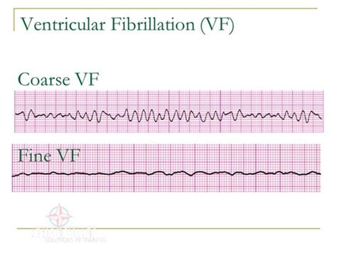 Coarse Ventricular Fibrillation