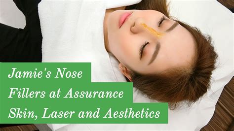 Blogger Jamies Nose Fillers At Assurance Skin Laser And Aesthetics