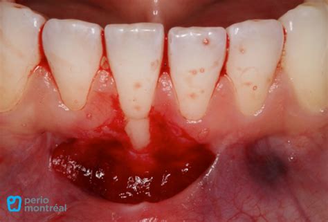 Free Gingival Graft for the Treatment of a Mucogingival Deformity ...