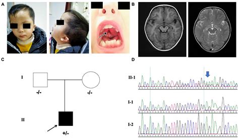 Frontiers MN1 Neurodevelopmental Disease Atypical Phenotype Due To A