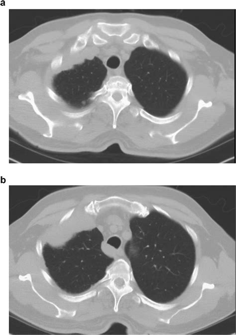 A And B CT Scan Of The Chest Revealing Right Sided Pleura Based