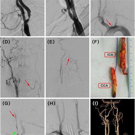 A Severe Stenosis Of The Left Vertebral Artery VA Ostium Was