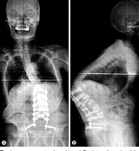 Figure From Proximal Junctional Kyphosis And Proximal Junctional