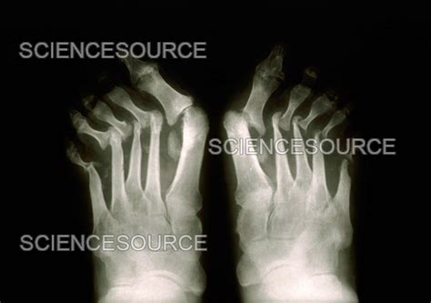 Psoriatic Arthritis X Ray