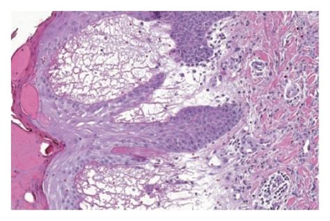 Skin biopsy showing severe dermatitis with epidermal spongiosis ...