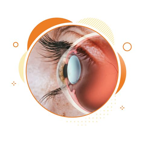 Cornea Transplant Surgery In Maharashtra Cornea Specialist