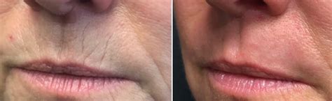 Laser Resurfacing Erbium Co2 Sciton Fraxel Lasers Victoria Park