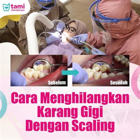 Cara Menghilangkan Karang Gigi Dengan Scaling Dan Cara Perawatannya