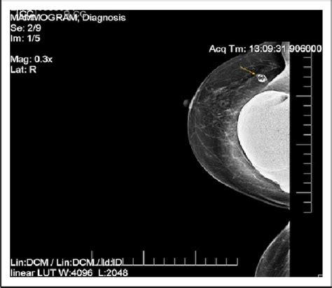 Figure 1 From Sonographic Confirmation Of Intracapsular And Extracapsular Breast Implant Rupture