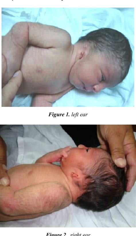 Figure 1 From Report Of Bilateral Microtia In 2 Successive Female