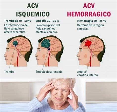 ¿por Qué El 29 De Octubre Es El Día Mundial Del Acv Filo News