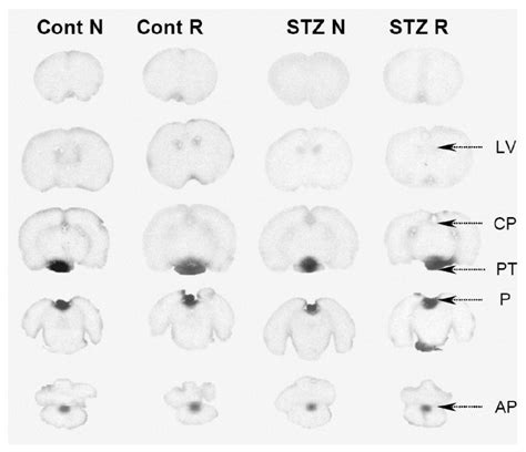 Glutamate Permeability At The Blood Brain Barrier In Insulinopenic And