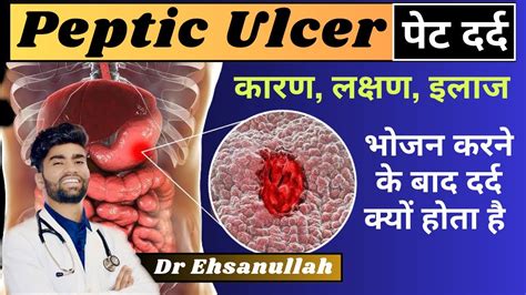 Peptic Ulcer In Hindi खाना खाने के बाद पेट में दर्द क्यों कारण लक्षण इलाज Dr Ehsanullah