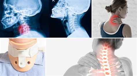 Neck Braces For Neck Pain | Pain Management Specialists