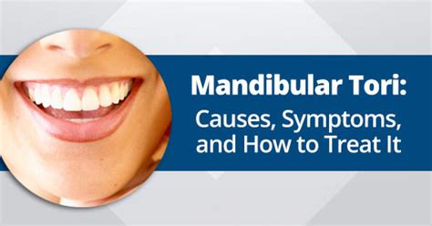 Mandibular Tori Causes Symptoms And How To Treat It