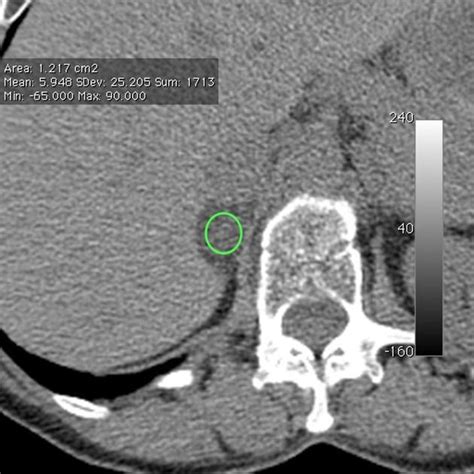 Adrenal adenoma | Radiology Reference Article | Radiopaedia.org