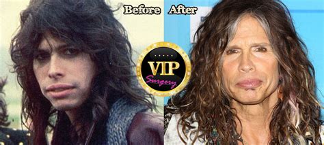 steven tyler plastic surgery | Surgery VIP