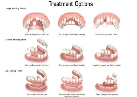 Snap In Dentures Benefits Drawbacks Costs And Care