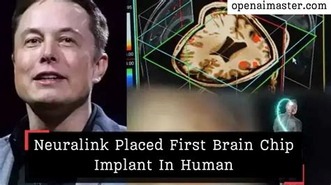 Neuralink Placed First Brain Chip Implant In Human - Open AI Master