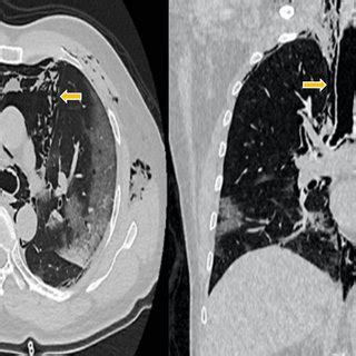 Chest Computed Tomography Ct At Admission Showing Pneumomediastinum