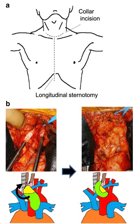 Details of surgery for tracheoesophageal fistula (TEF). a The schema of... | Download Scientific ...