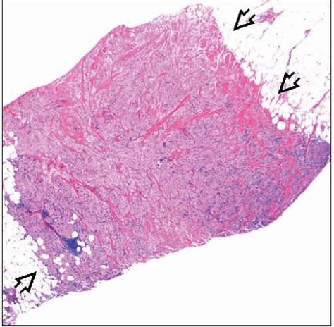 Granular Cell Tumor Basicmedical Key