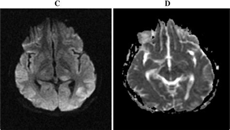 Axial Dwi And Adc Map Images Show Restriction Diffusion Indicated By