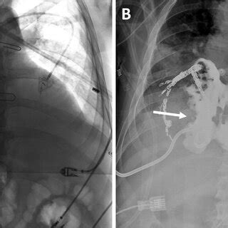 A A Single 23 Mm X 120 Mm Stent Graft Was Deployed Across The