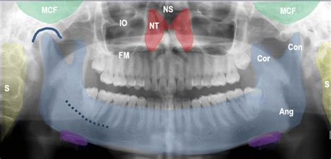 Pediatric Panoramic Radiography Techniques Artifacts And