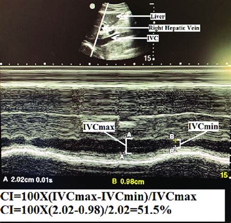 M Mode Measurement Of The Inferior Vena Cava Ivc Inferior Vena Cava