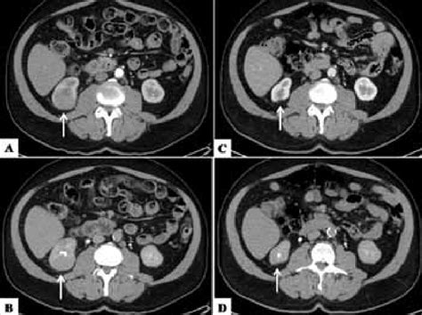 Case 1 Axial Ct Images Through The Lower Poles Of The Kidneys A