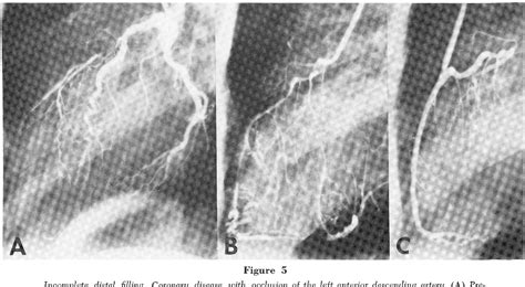 Figure 1 From Radiologic Notes In Cardiology Angiographie Appraisal Of Distal Vessel Suitability