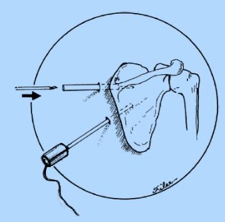 Scapulothoracic Bursitis | Boston Shoulder Institute