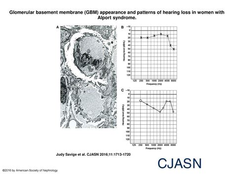 Glomerular Basement Membrane GBM Appearance And Patterns Of Hearing