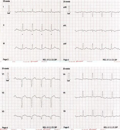 Pathway Stemi