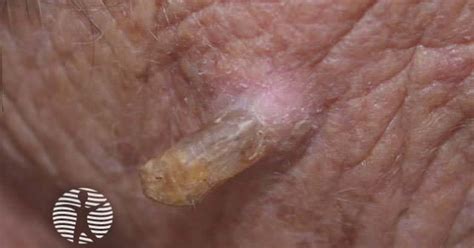 Dermnet Cutaneous Horn Image