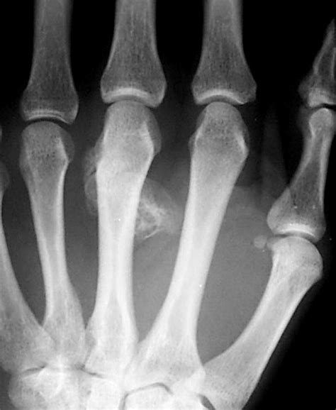 Pathology Outlines Bizarre Parosteal Osteochondromatous Proliferation