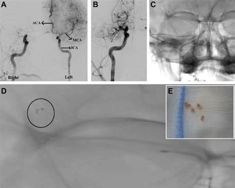 E A Intra Arterial Digital Subtraction Angiography Iadsa Showing Download Scientific Diagram