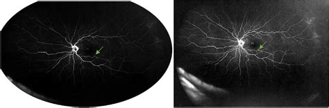 Os Early Left And Late Right Phase Fluorescein Angiography Download Scientific Diagram