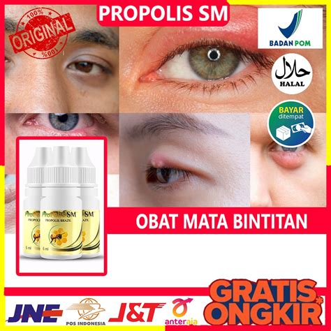 Jual Obat Mata Bintitan Benjolan Di Kelopak Mata Kalazion Mata