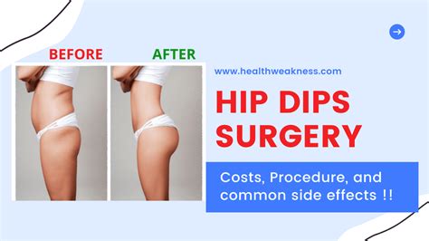 Hip Dips Surgery In 2024 Costs Procedure And Common Side Effects