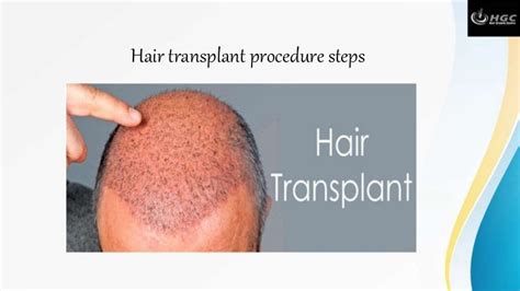 Hair transplant procedure steps