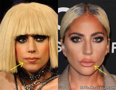 Lady Gaga Nose Job Before After