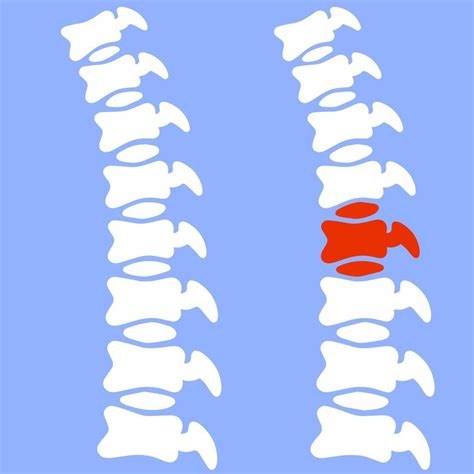 Problems With The Spine Crack In Intervertebral Disc Pain And Trauma