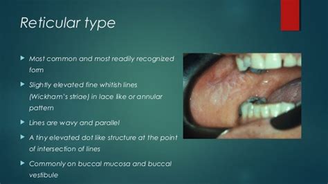 Oral Lichen Planus