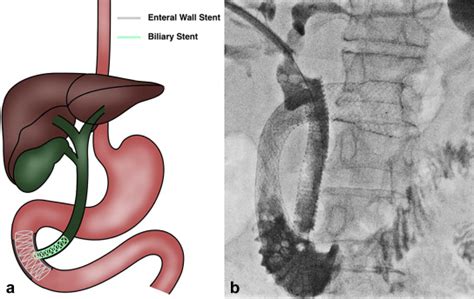 Transhepatic Approach For Retrograde D2 Duodenal Stent Placement New Technique And Case Series