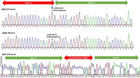 Sanger Sequencing Of The Splice Site Mutation In Both Genomic Dna Cdna