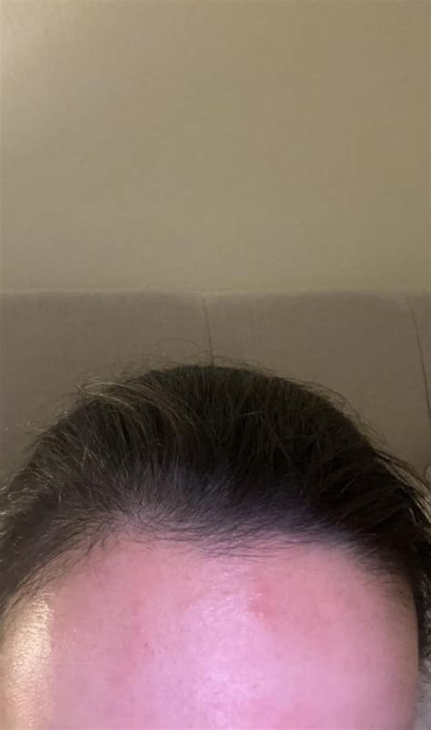 [routine Help] Closed Comedones Of Fungal Acne R Skincareaddiction