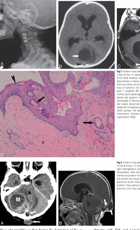 Figure 1 From Posterior Fossa Dermoid Cysts In Association With Klippel