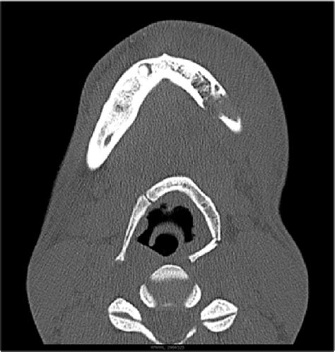 Hyoid Bone Ct Scan